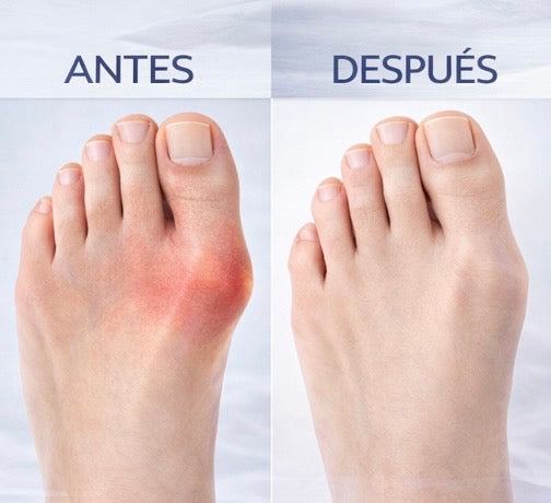 Corrector Ortopédico para Juanetes – Ajuste Cómodo y Estable